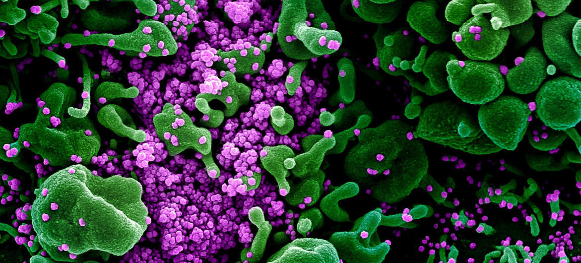 Institutos Nacionales de la Salud de Estados Unidos (NIH) Una imagen digitalmente aumentada de una muestra de un paciente presenta células verdes muy infectadas con la partícula de virus SARS-COV-2 de color púrpura.